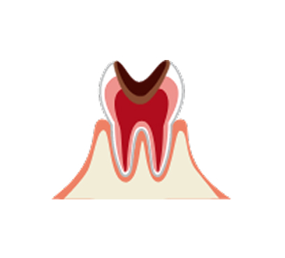進行した段階 (C2, C3)
