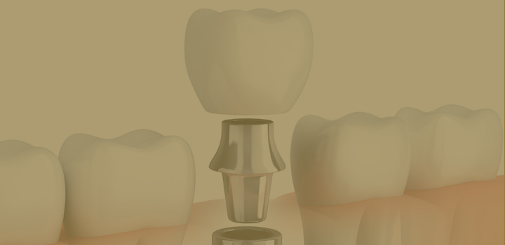 歯を失って噛みにくい インプラント