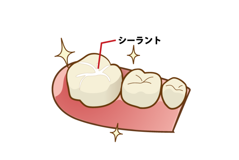 歯を削らずに予防するシーラント