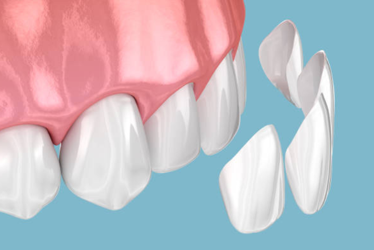 ラミネートベニア